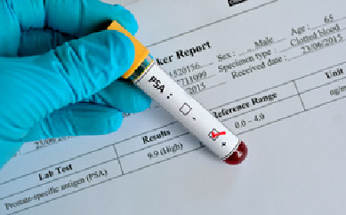 آزمایش خون PSA